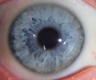 Iridology - What Does This Iris Tell Me?