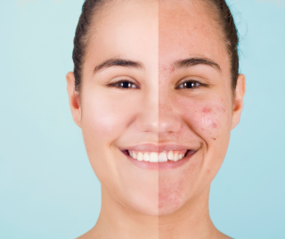 Acne & the Healing Benefits of Real Food